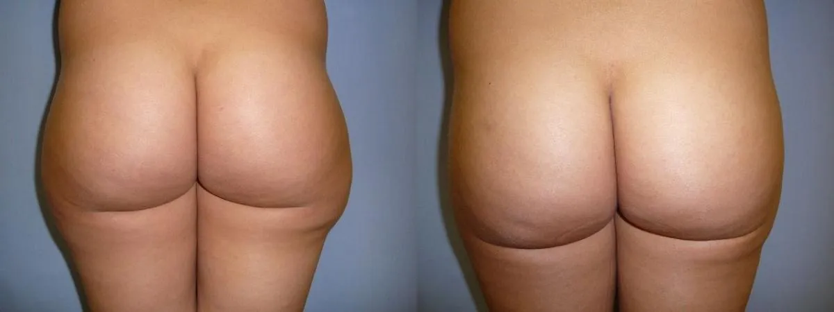 Ліпосакція – результат 9