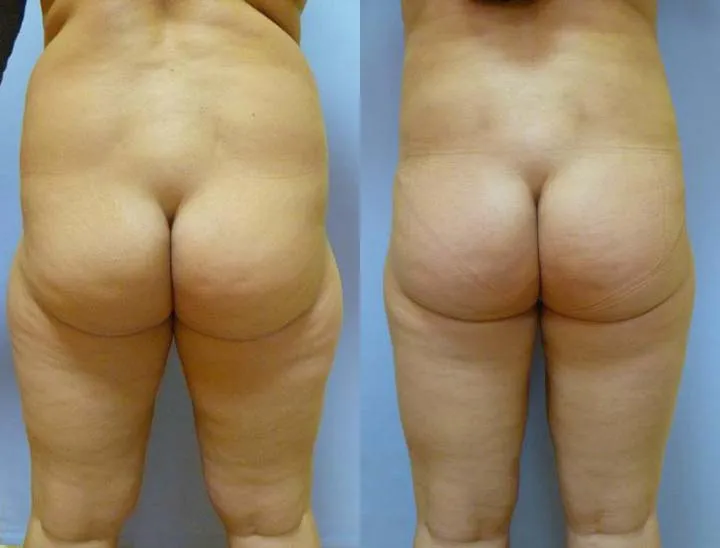 Ліпосакція – результат 10