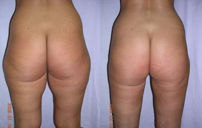 Ліпосакція – результат 11