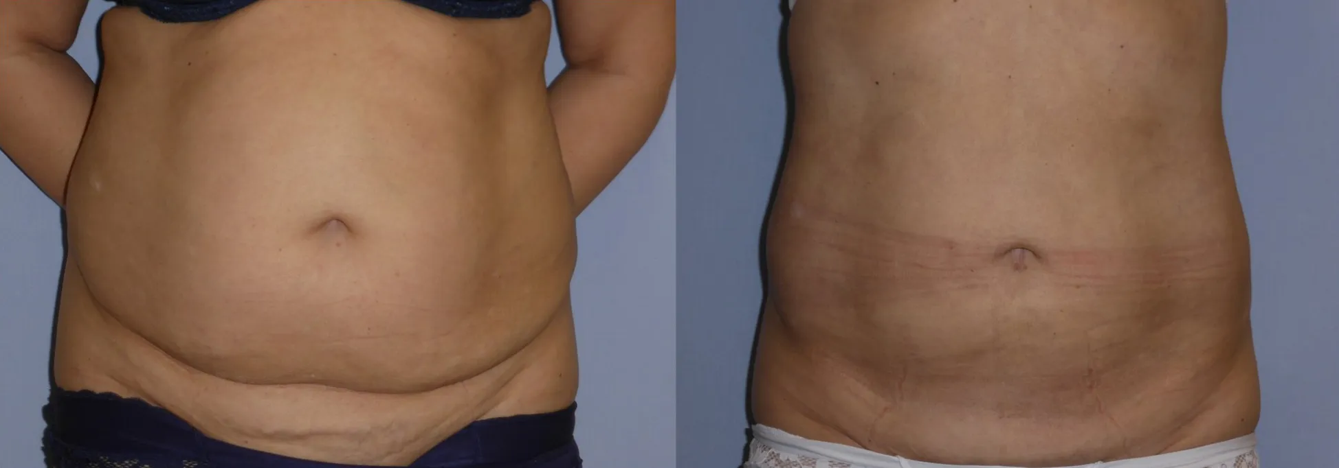 Ліпосакція – результат 12