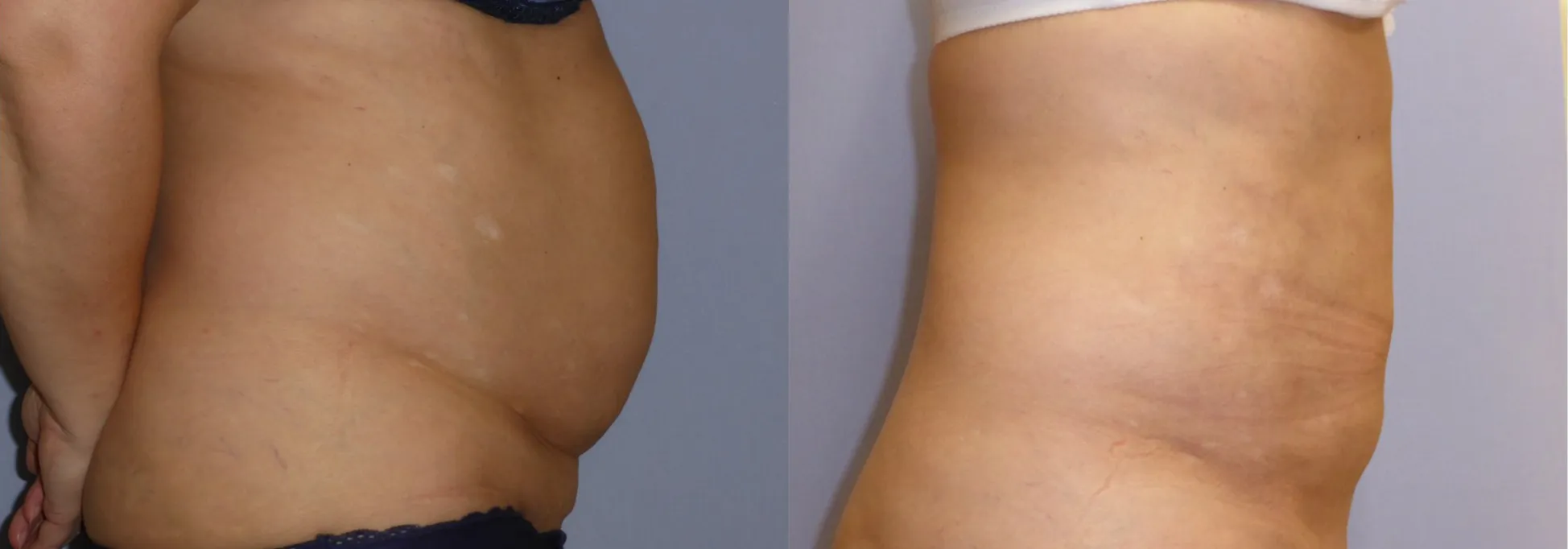 Ліпосакція – результат 13