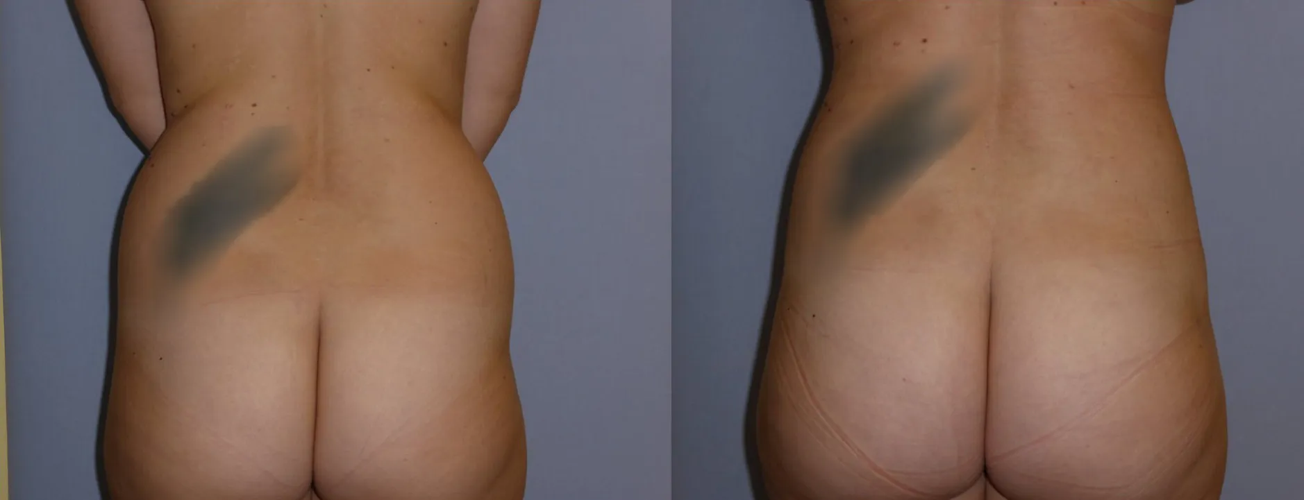 Ліпосакція – результат 14