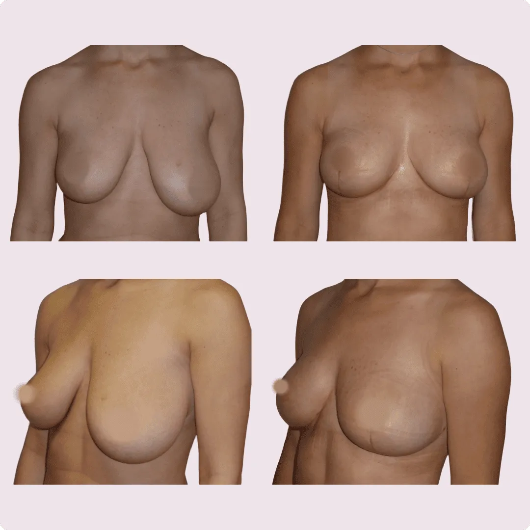 Bruststraffung (Lifting) – Ergebnis 1