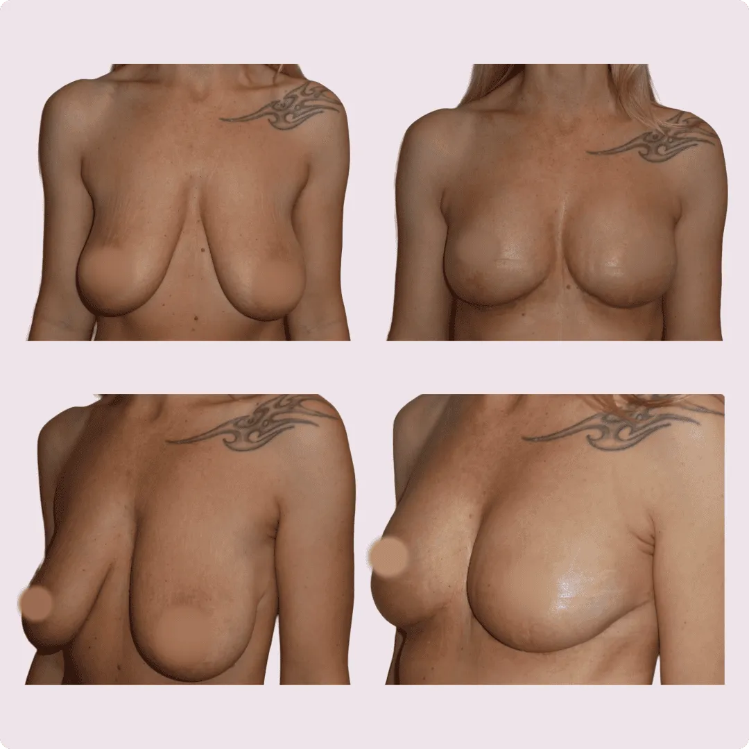 Bruststraffung (Lifting) – Ergebnis 2