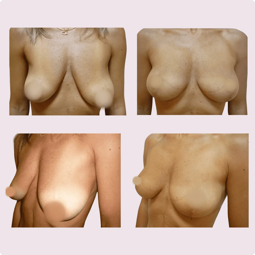 Bruststraffung (Lifting) – Ergebnis 4