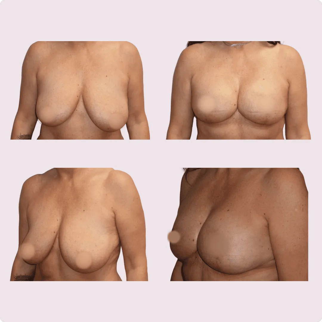 Bruststraffung (Lifting) – Ergebnis 5
