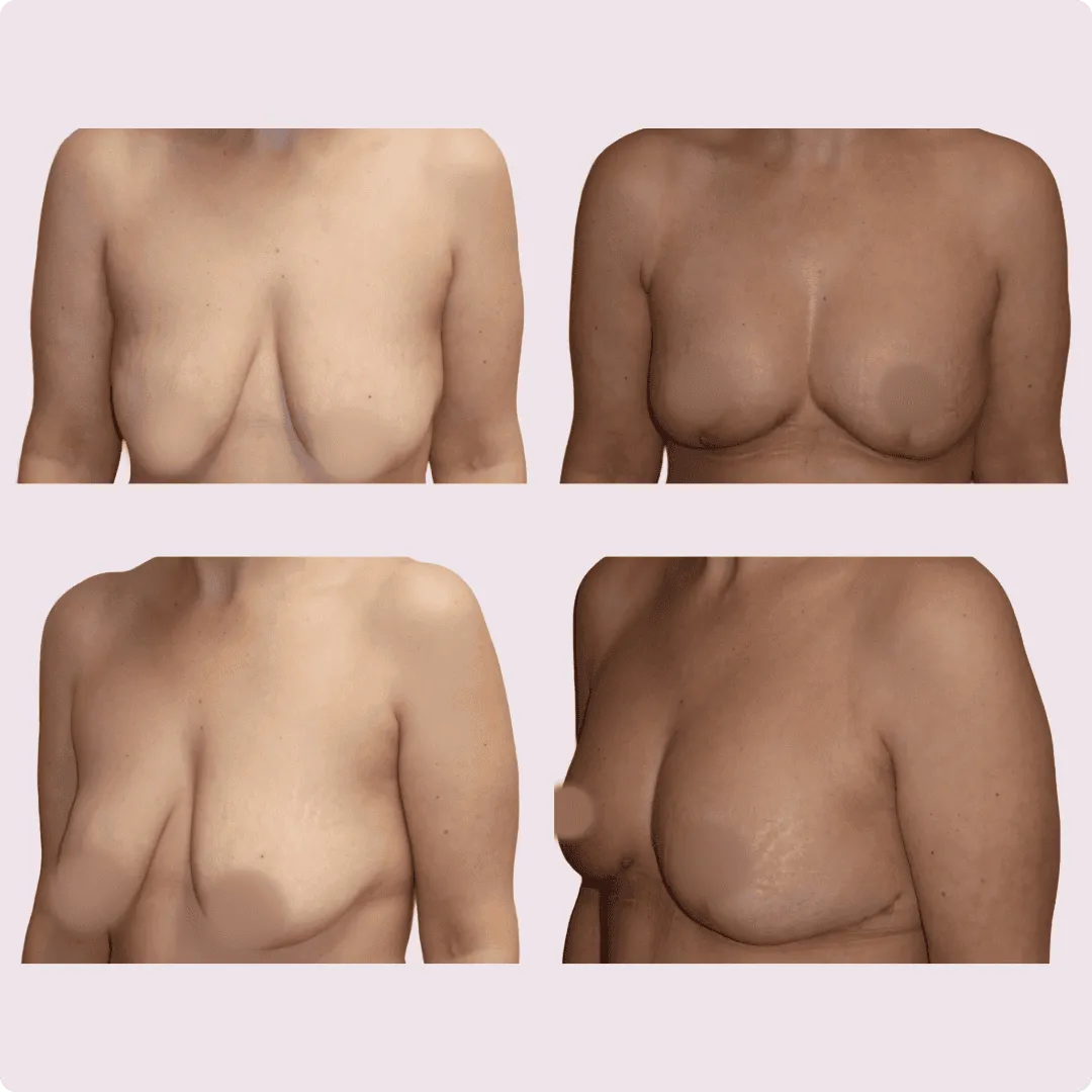Bruststraffung (Lifting) – Ergebnis 6