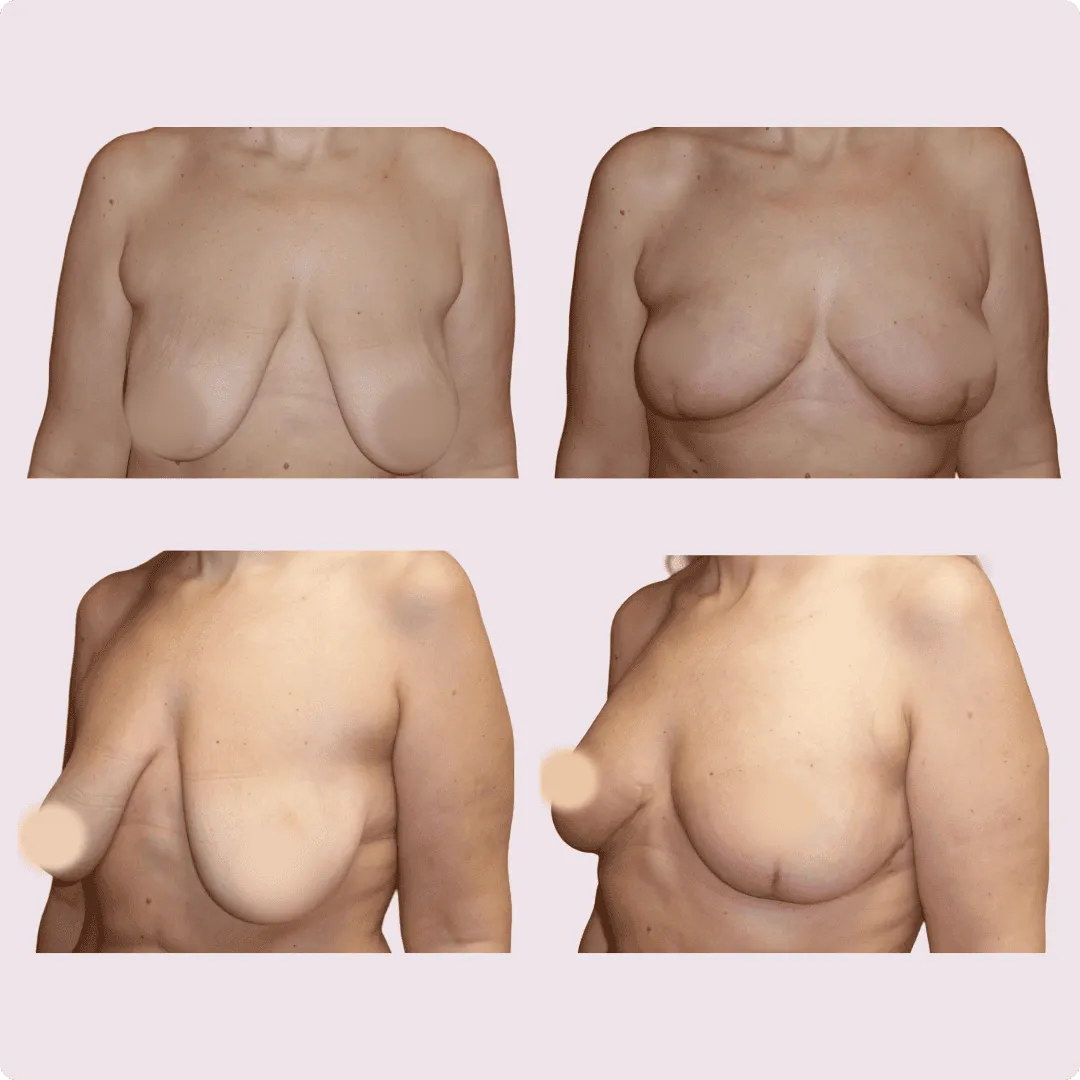 Bruststraffung – Mastopexie – Ergebnis 14