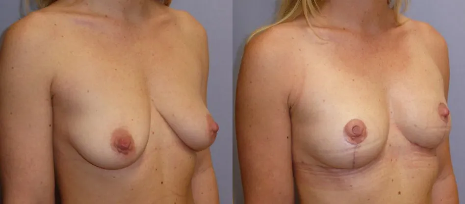 Моделювання грудей (Ліфтинг) – результат 2