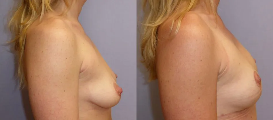 Моделювання грудей – Мастопексія – результат 6