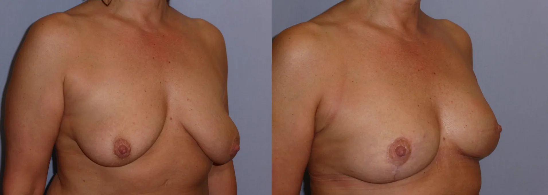 Моделювання грудей – Мастопексія – результат 7