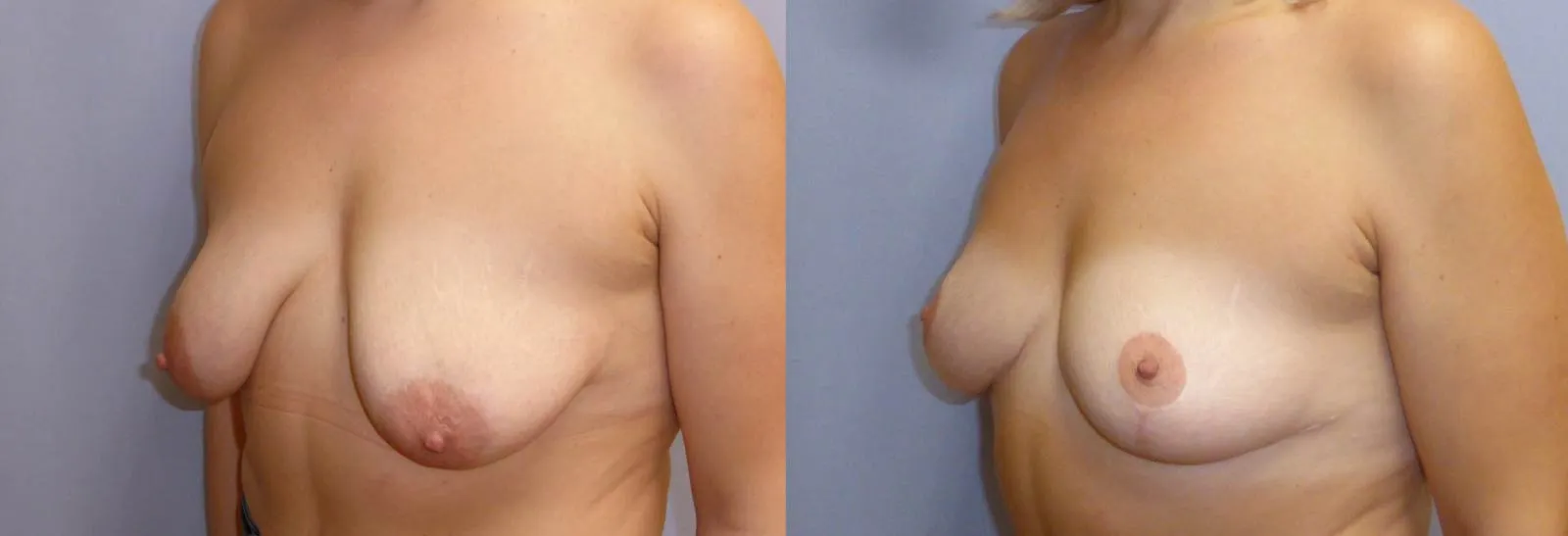 Моделювання грудей – Мастопексія – результат 8