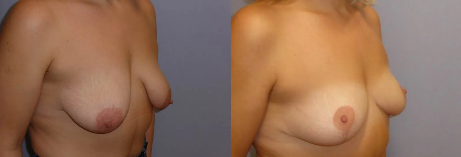 Моделювання грудей – Мастопексія – результат 9