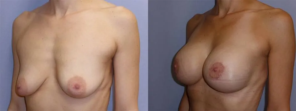 Моделювання грудей – Мастопексія – результат 11