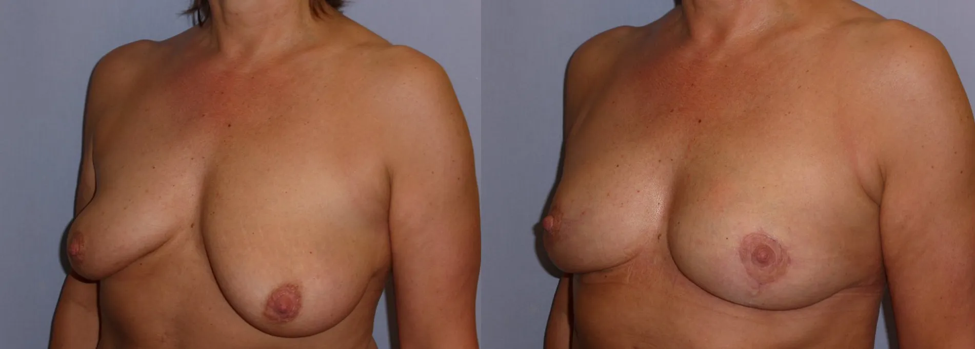 Моделювання грудей (Ліфтинг) – результат 3