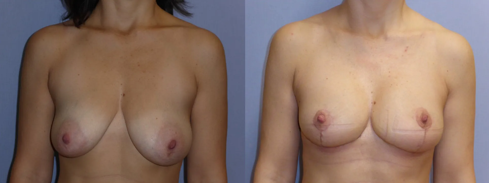 Моделювання грудей – Мастопексія – результат 13