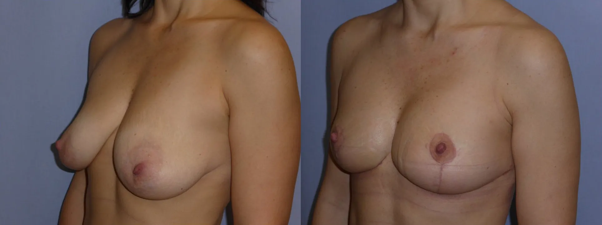 Моделювання грудей – Мастопексія – результат 14