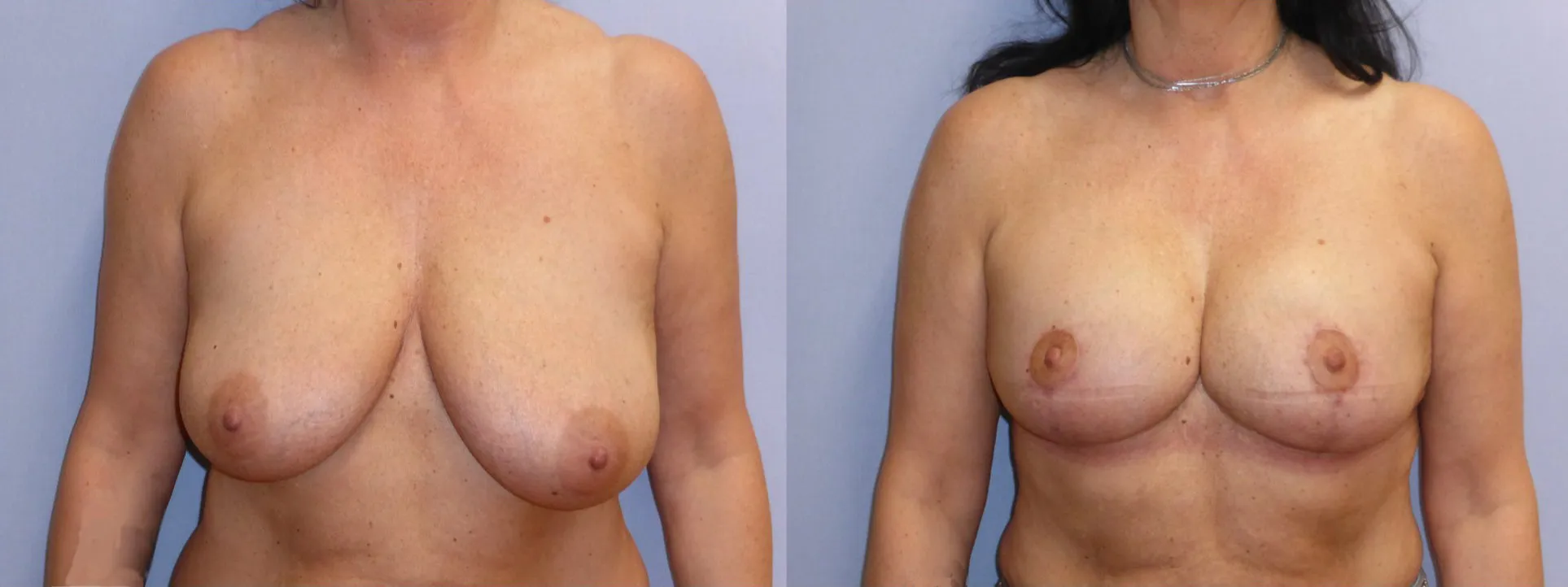 Моделювання грудей – Мастопексія – результат 15