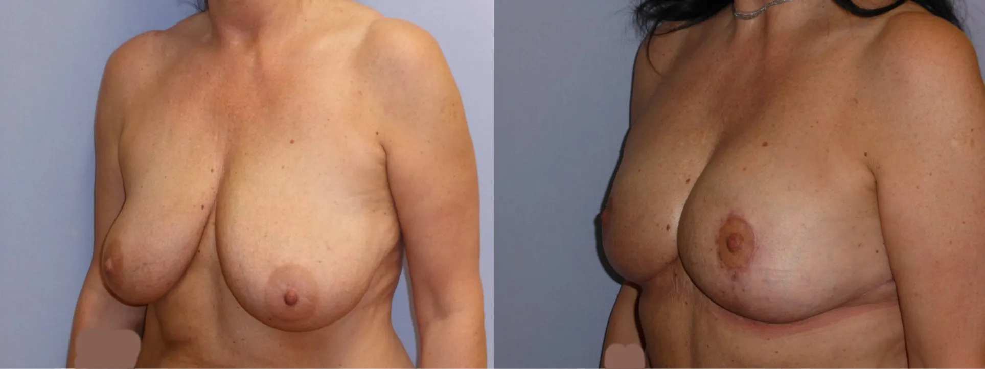 Моделювання грудей – Мастопексія – результат 16