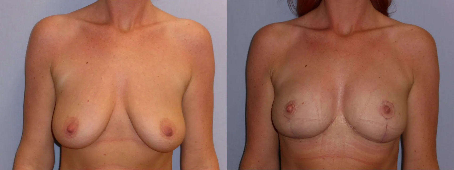 Моделювання грудей – Мастопексія – результат 17