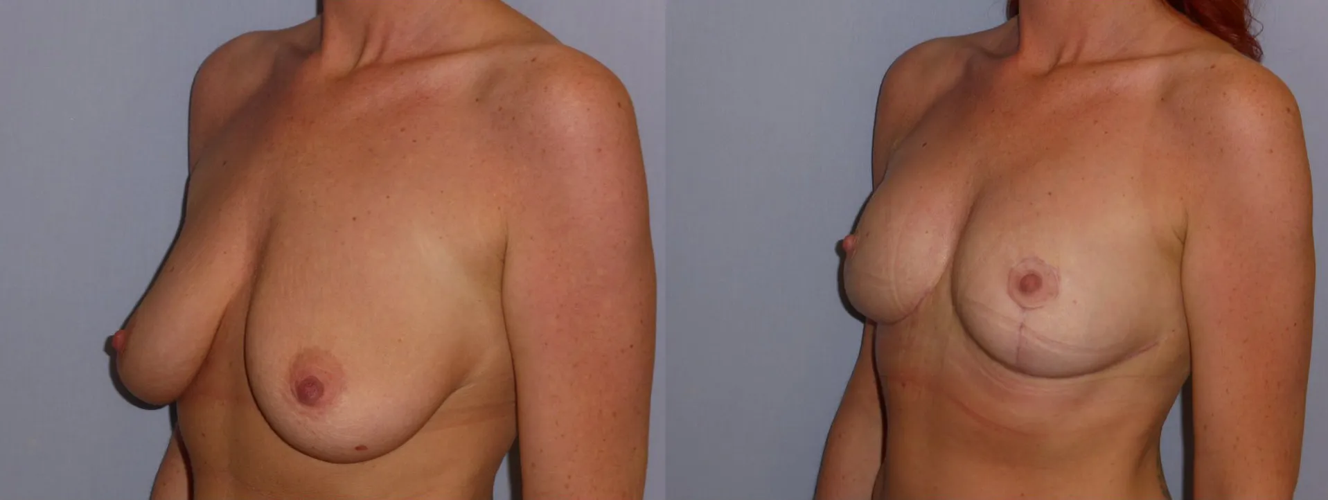 Моделювання грудей – Мастопексія – результат 18