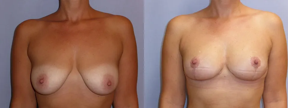 Моделювання грудей (Ліфтинг) – результат 4