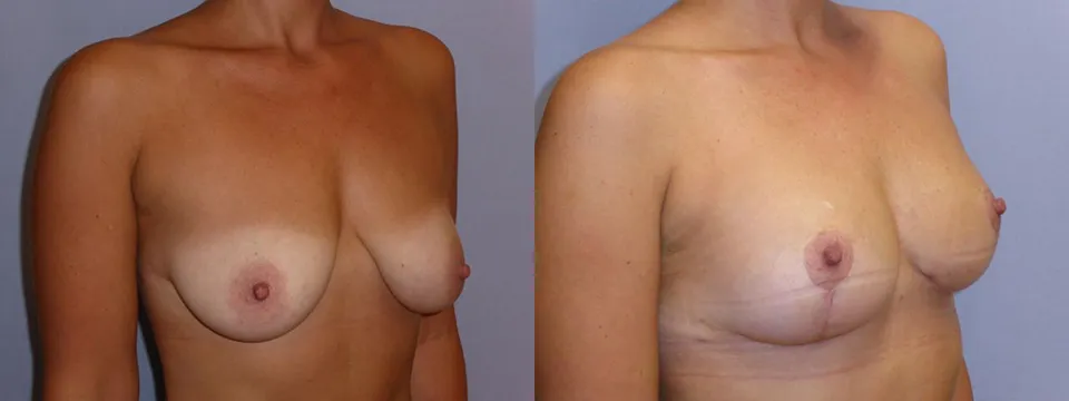 Моделювання грудей – Мастопексія – результат 20