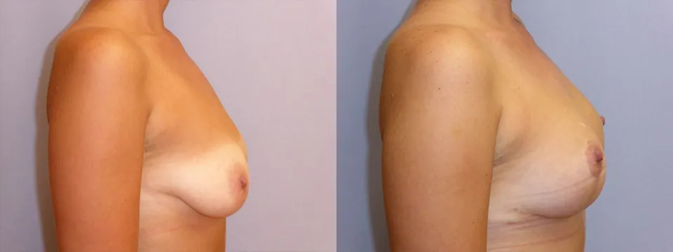 Моделювання грудей – Мастопексія – результат 21