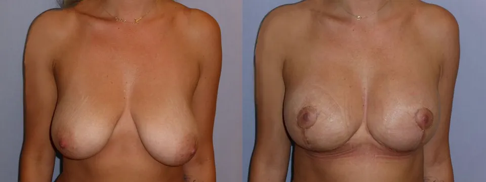 Моделювання грудей – Мастопексія – результат 24