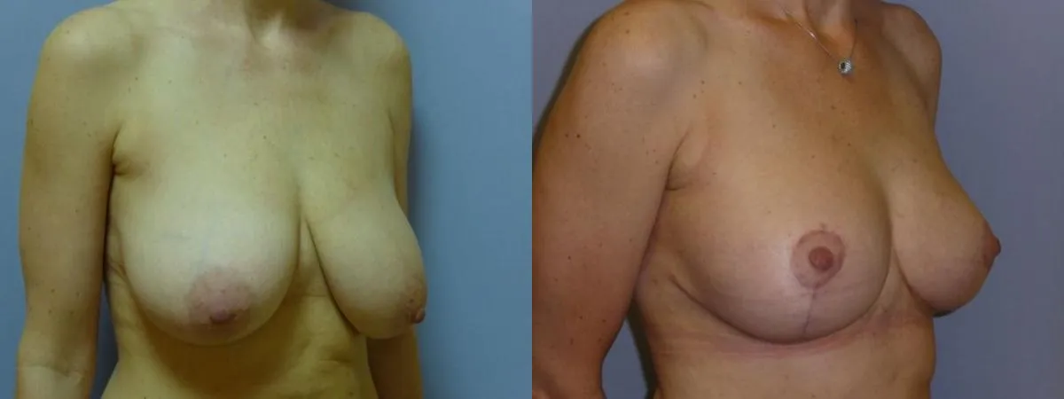 Моделювання грудей – Мастопексія – результат 28