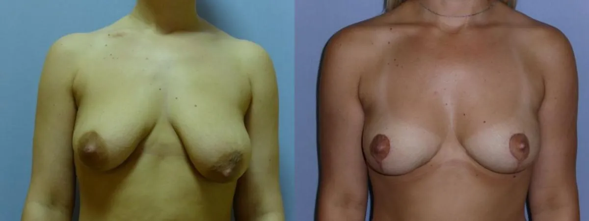 Моделювання грудей – Мастопексія – результат 29