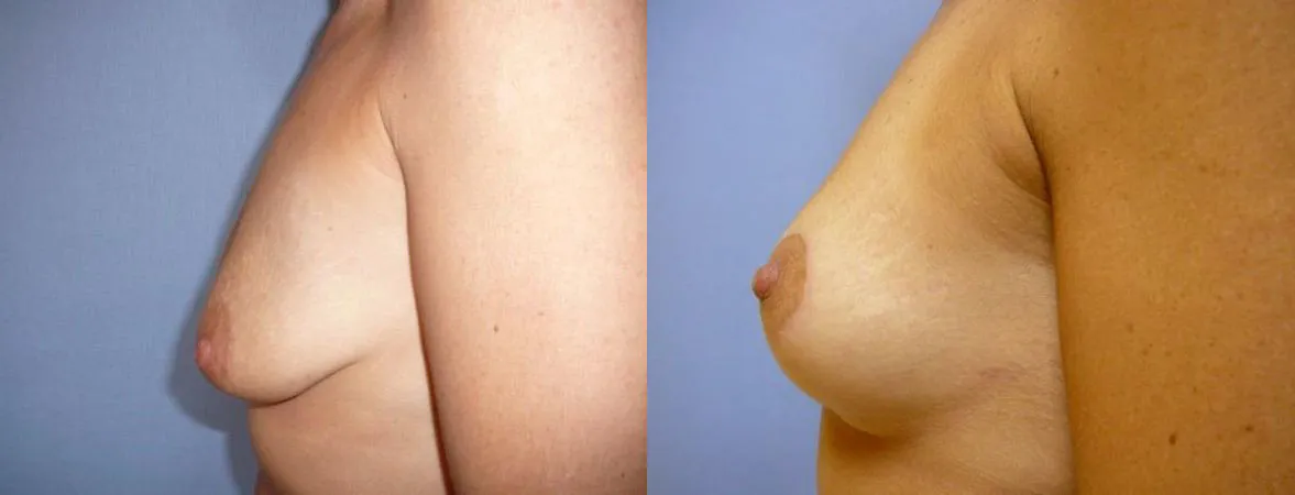 Моделювання грудей – Мастопексія – результат 30