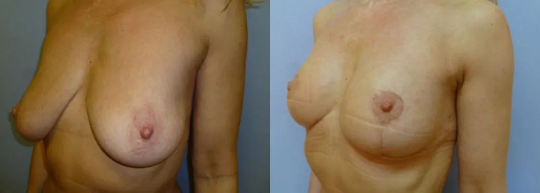 Моделювання грудей – Мастопексія – результат 32