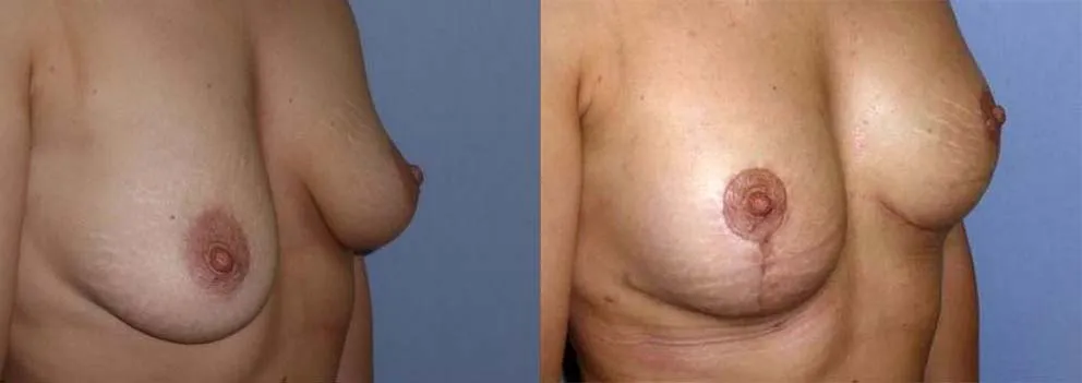 Моделювання грудей (Ліфтинг) – результат 6