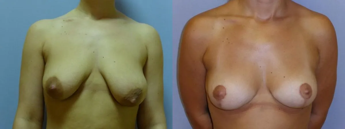 Моделювання грудей – Мастопексія – результат 34
