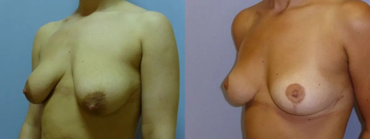 Моделювання грудей – Мастопексія – результат 35