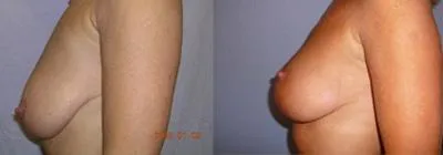 Моделювання грудей – Мастопексія – результат 36