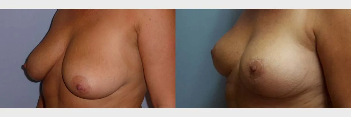 Моделювання грудей – Мастопексія – результат 38