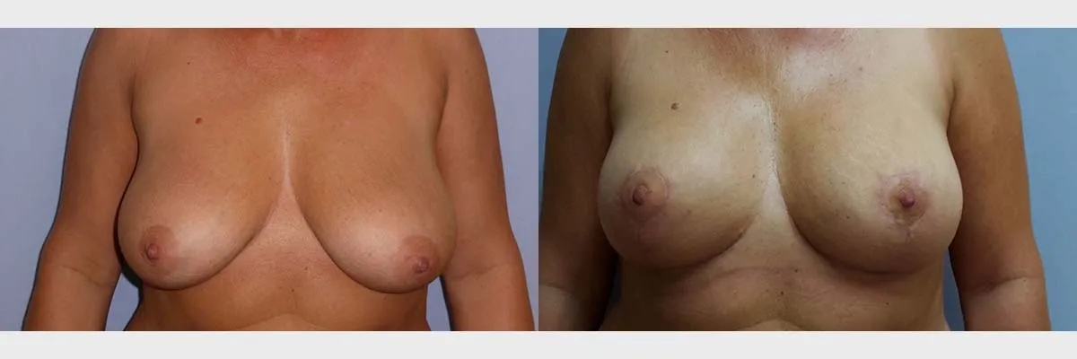 Моделювання грудей – Мастопексія – результат 39