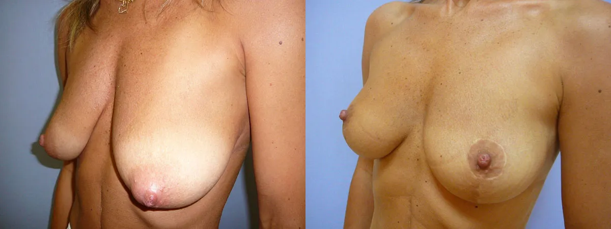 Моделювання грудей – Мастопексія – результат 41