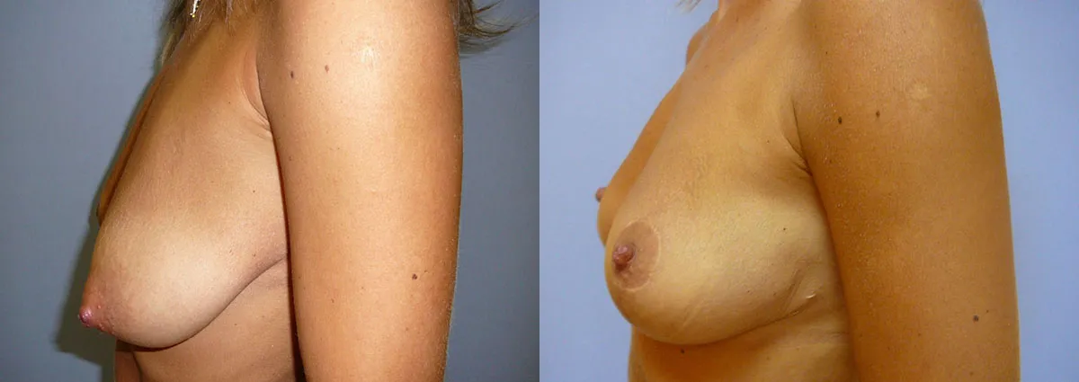 Моделювання грудей – Мастопексія – результат 42