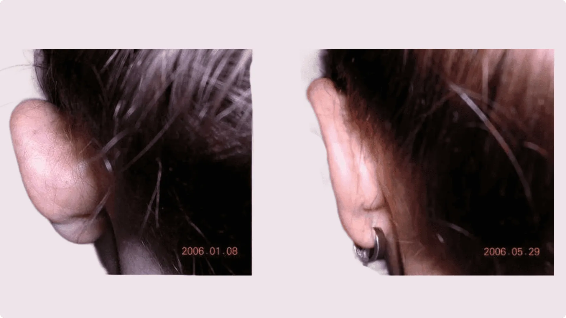 Upnutí uší (Otoplastika) – fotografie před a po 1