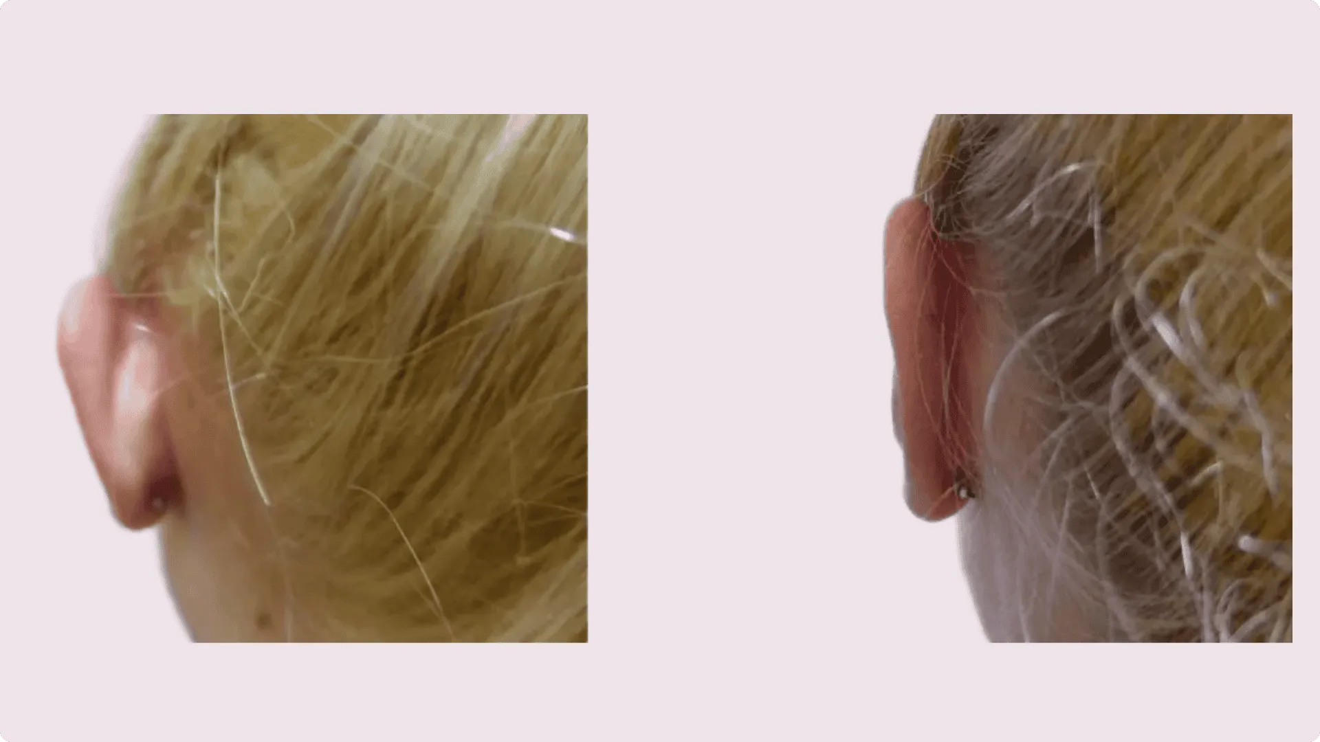 Upnutí uší (Otoplastika) – fotografie před a po 2