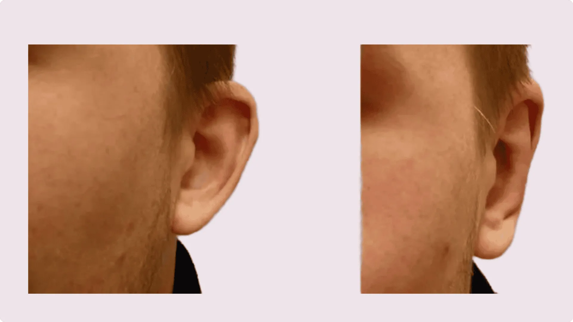 Upnutí uší (Otoplastika) – fotografie před a po 5