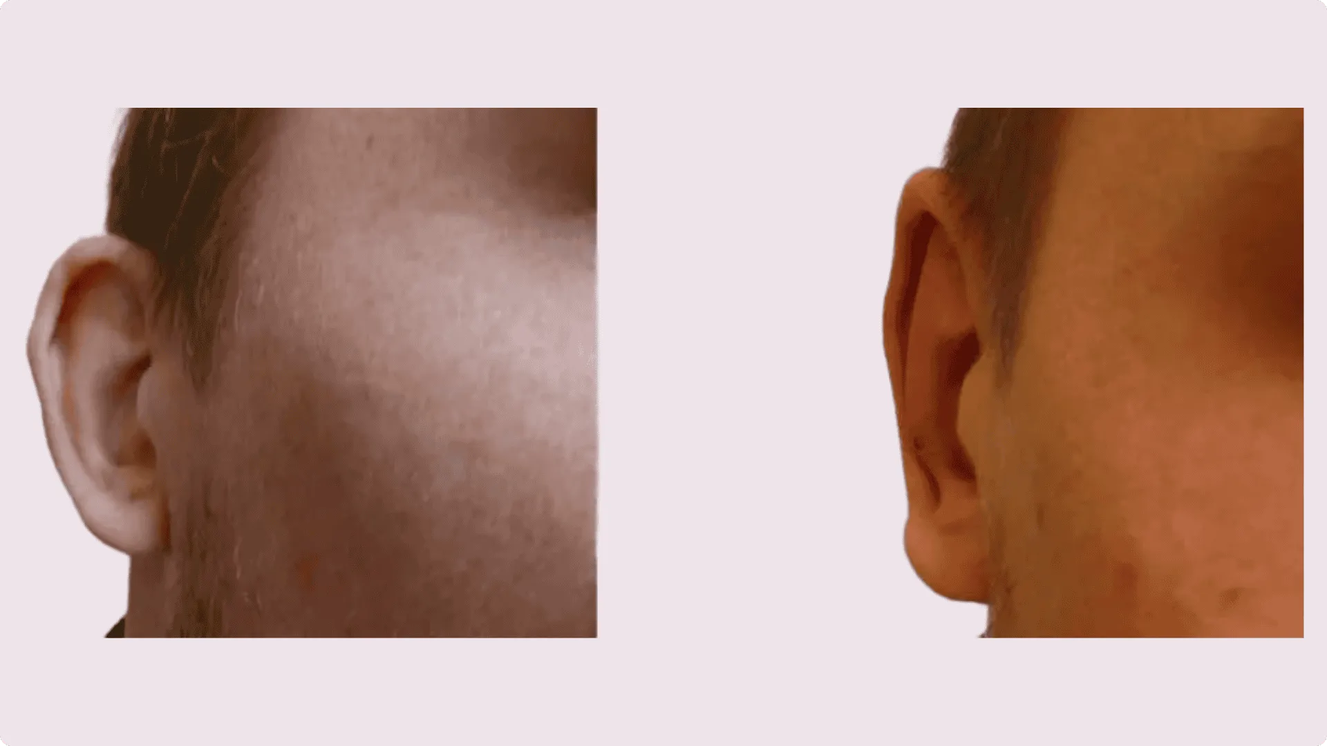 Upnutí uší (Otoplastika) – fotografie před a po 6