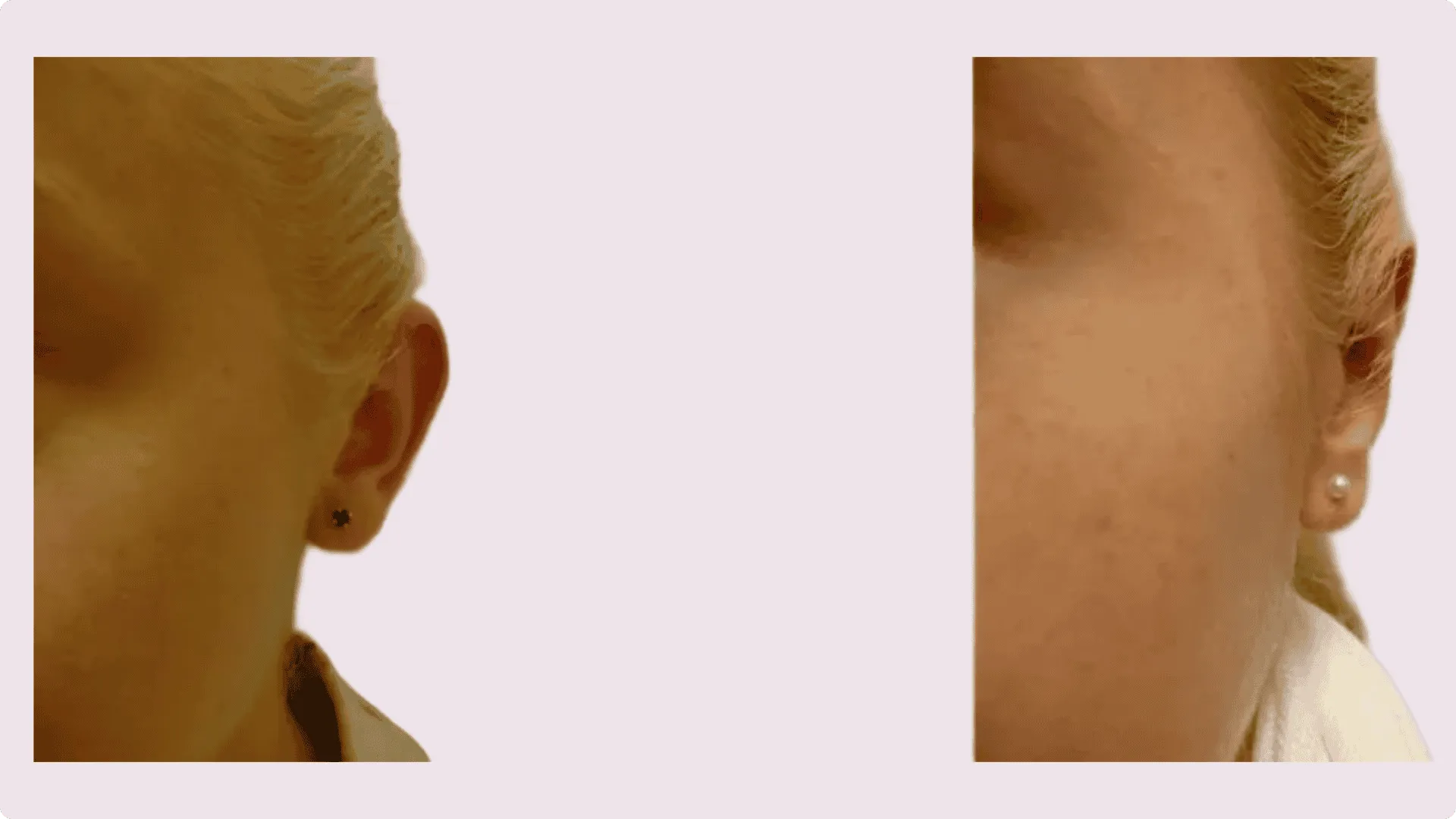 Ear Correction – Otoplasty – before and after photo 4