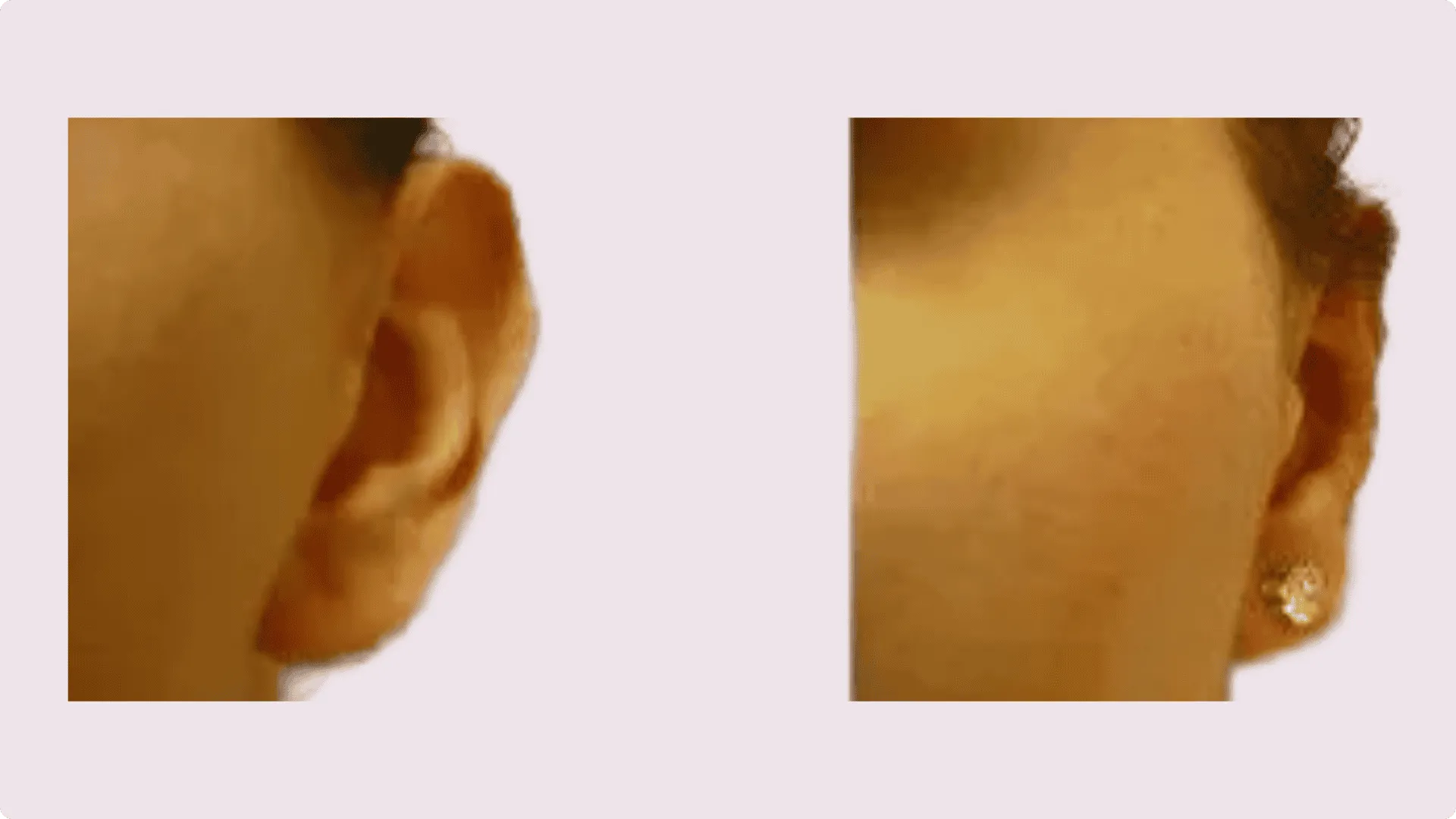 Ear Correction – Otoplasty – before and after photo 5