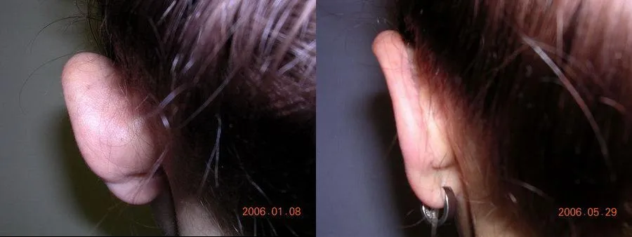 Корекція вух (Отопластика) – результат 1