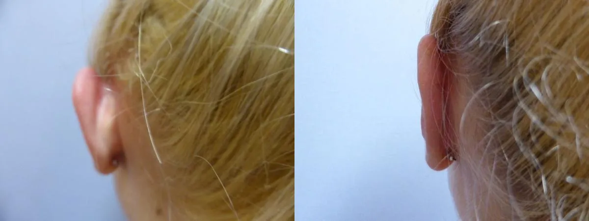 Корекція вух (Отопластика) – результат 2