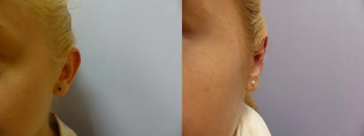 Корекція вух (Отопластика) – результат 3